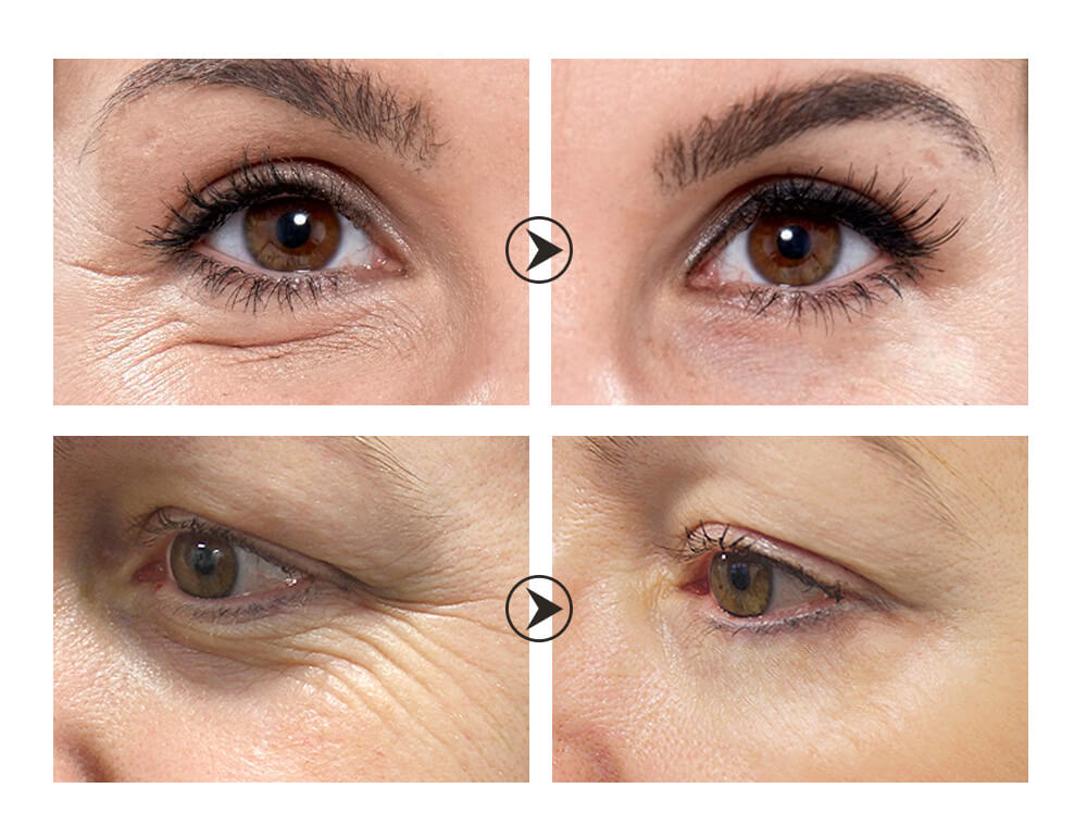 Is eye cream really useful? (Is it necessary to use eye cream? Answers from authoritative experts!)