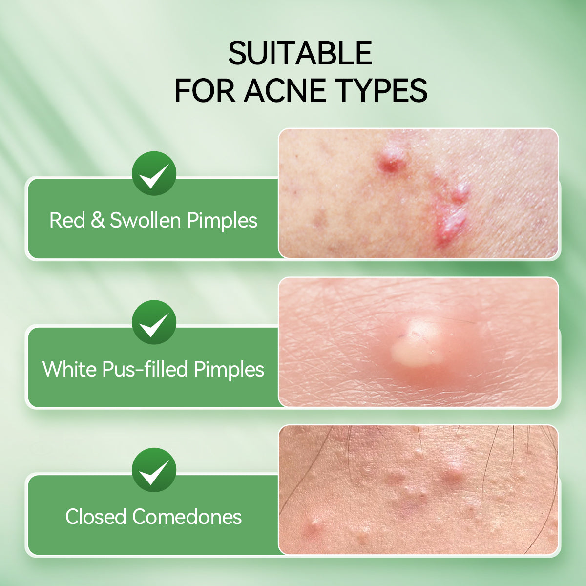 Precision Acne Spot Serum