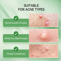 Precision Acne Spot Serum